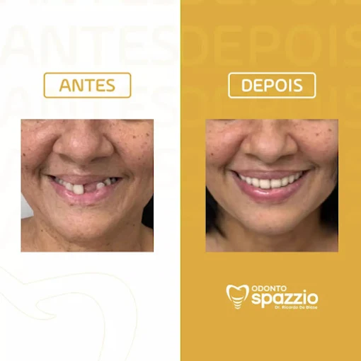 poretese dentaria Recife
